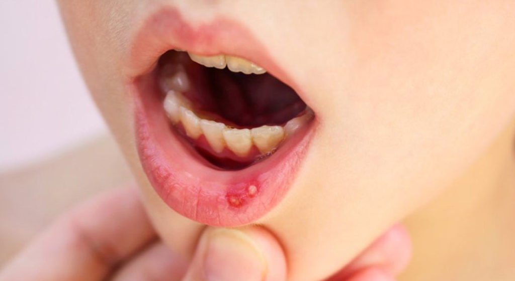 Лечение стоматита у детей цены в Новосибирске - Кропоткинская ...