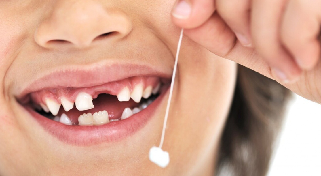 Удаление молочных зубов